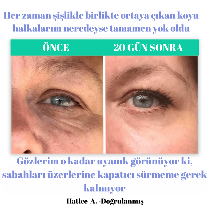 Lavinialuxe® Göz Altı Terapi Cihazı - LaviniaLuxe