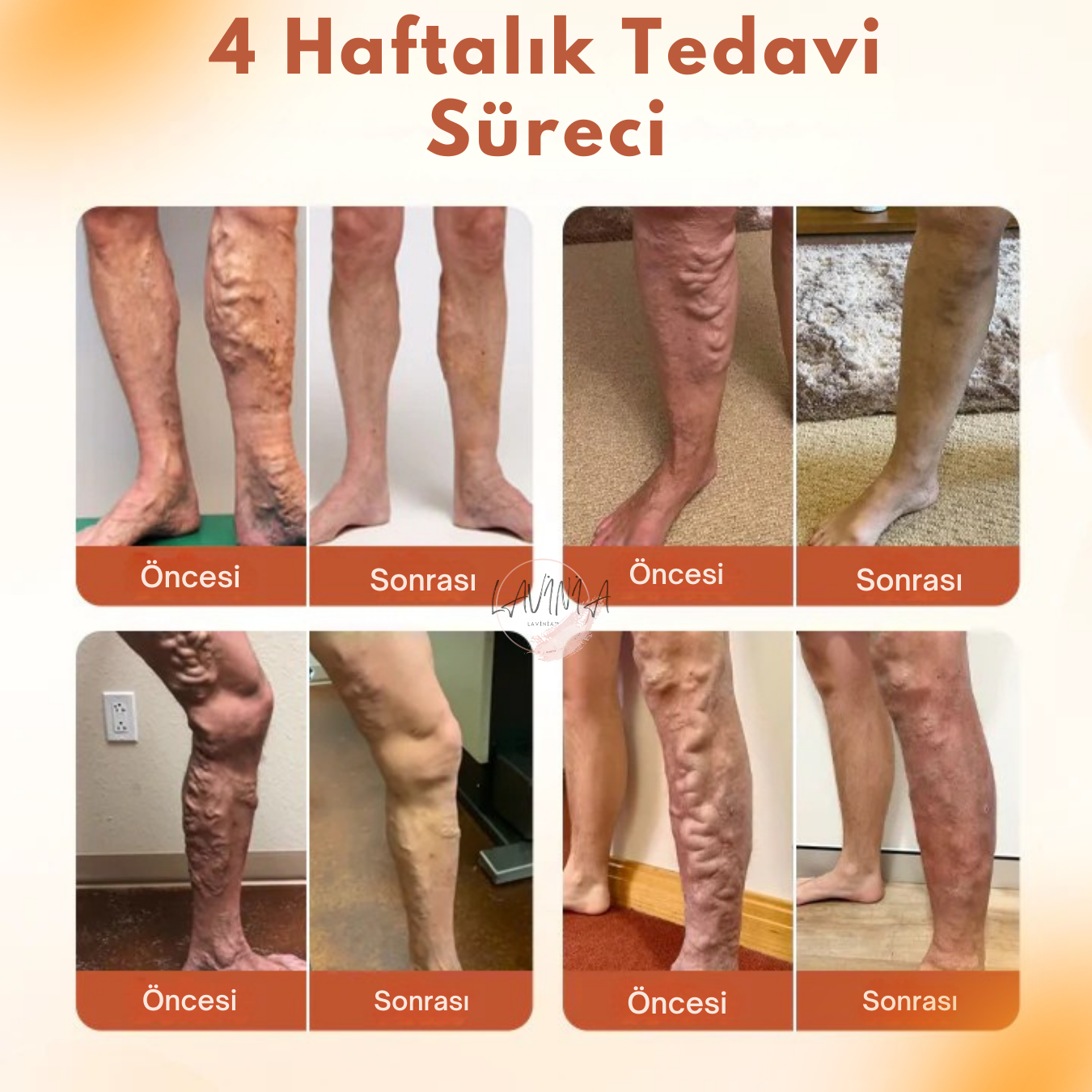 Lavinialuxe® Varis Tedavi Bandı | Şişlik, Yorgunluk ve Damar Sağlığı için Doğal Bitkisel Terapi