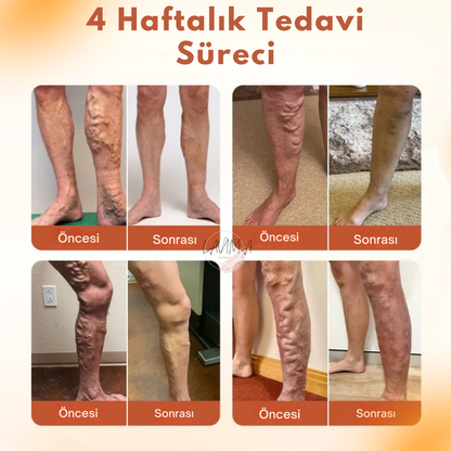 Lavinialuxe® Varis Tedavi Bandı | Şişlik, Yorgunluk ve Damar Sağlığı için Doğal Bitkisel Terapi