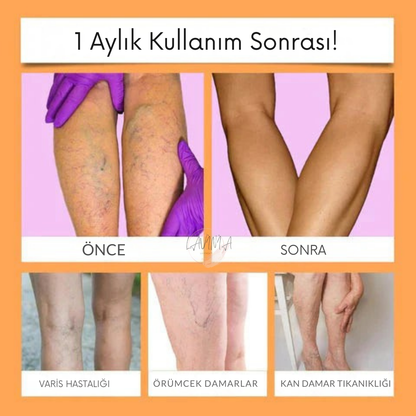 Lavinialuxe® Varis Tedavi Bandı | Şişlik, Yorgunluk ve Damar Sağlığı için Doğal Bitkisel Terapi