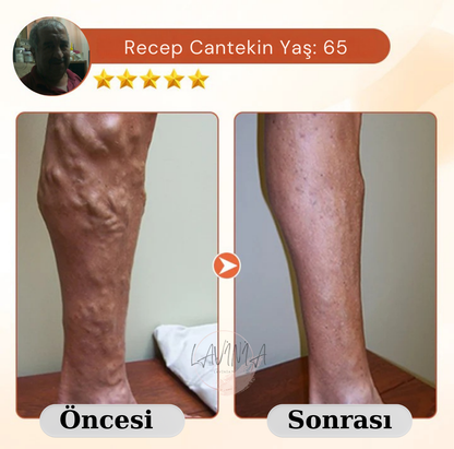 Lavinialuxe® Varis Tedavi Bandı | Şişlik, Yorgunluk ve Damar Sağlığı için Doğal Bitkisel Terapi