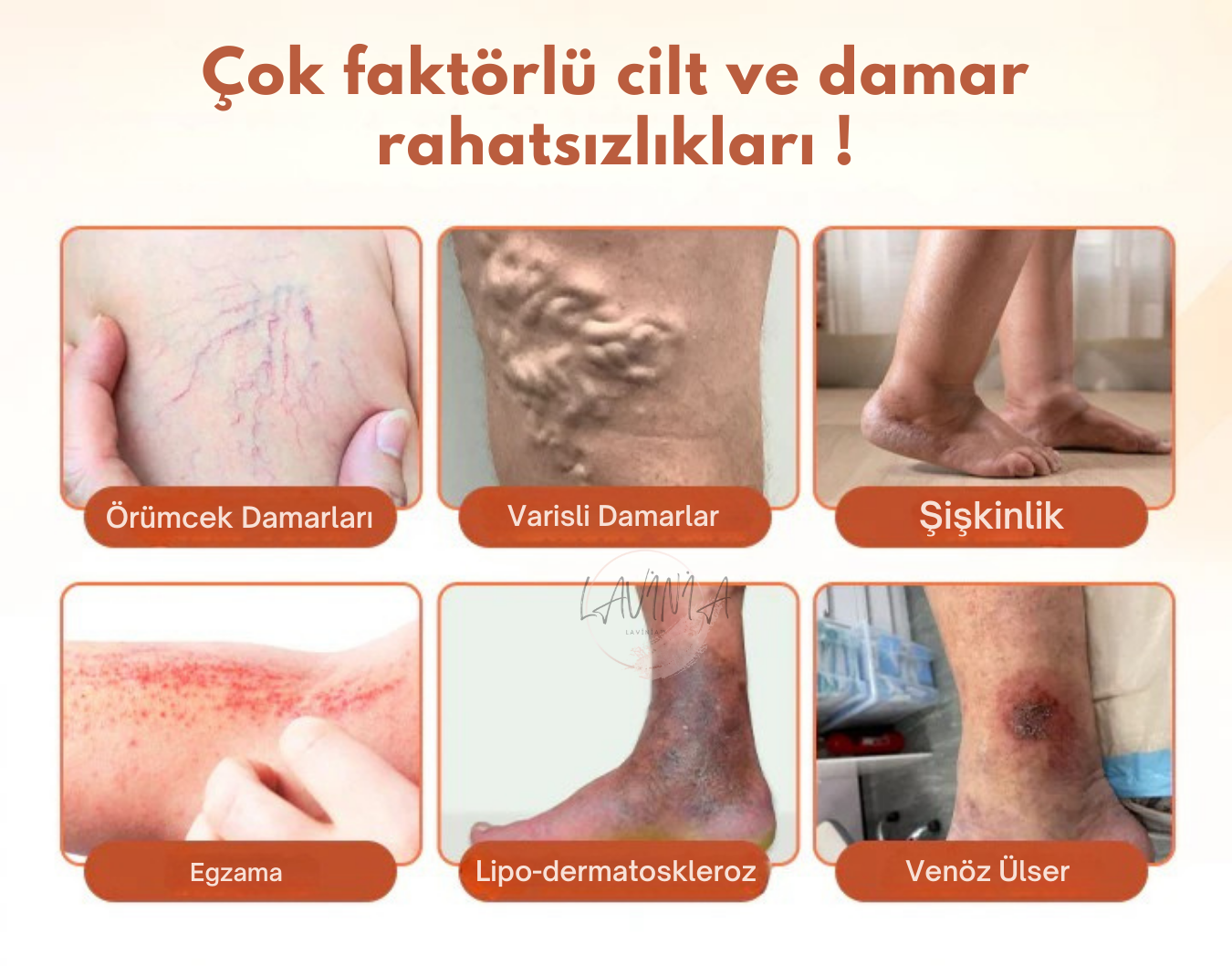Lavinialuxe® Varis Tedavi Bandı | Şişlik, Yorgunluk ve Damar Sağlığı için Doğal Bitkisel Terapi