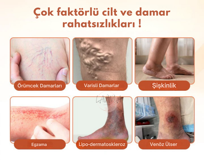 Lavinialuxe® Varis Tedavi Bandı | Şişlik, Yorgunluk ve Damar Sağlığı için Doğal Bitkisel Terapi