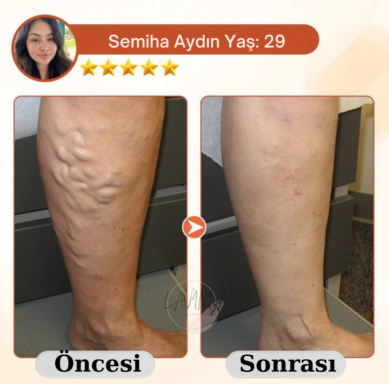 Lavinialuxe® Varis Tedavi Bandı | Şişlik, Yorgunluk ve Damar Sağlığı için Doğal Bitkisel Terapi