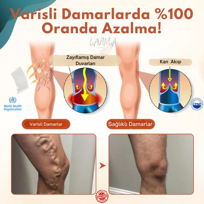 Lavinialuxe® Varis Tedavi Bandı | Şişlik, Yorgunluk ve Damar Sağlığı için Doğal Bitkisel Terapi
