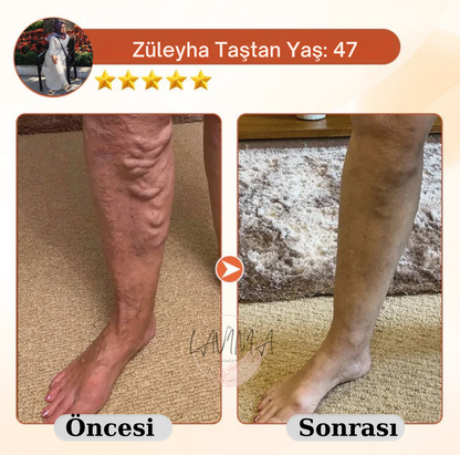 Lavinialuxe® Varis Tedavi Bandı | Şişlik, Yorgunluk ve Damar Sağlığı için Doğal Bitkisel Terapi